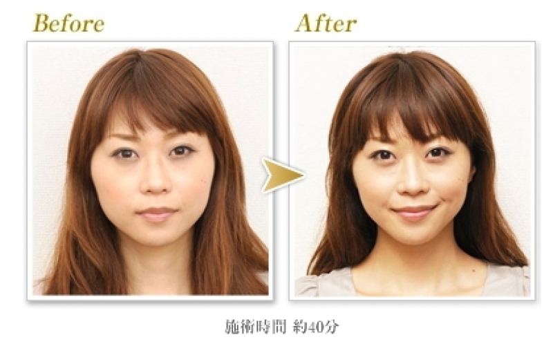 レミスティックの小顔矯正ビフォーアフター。施術時間40分